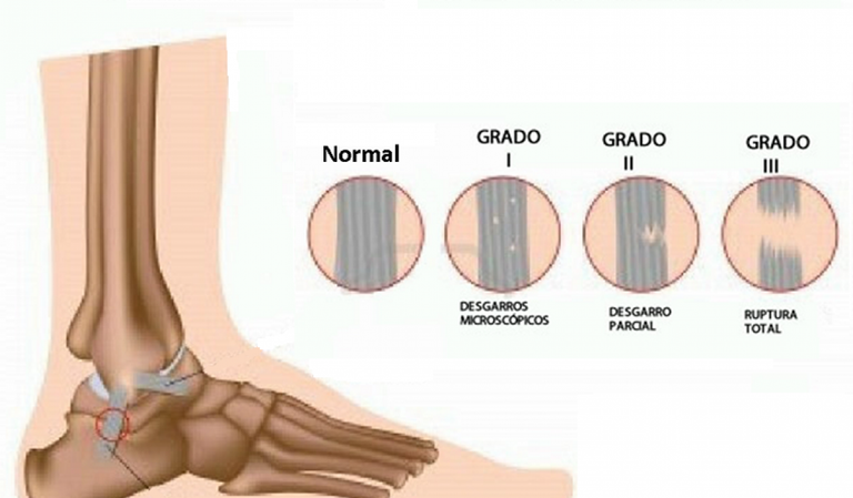 fisioterapia tobillo Igualada 2